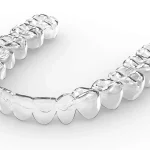 How Invisalign Aligner Tracking Systems Monitor Progress and Predict Treatment Milestones